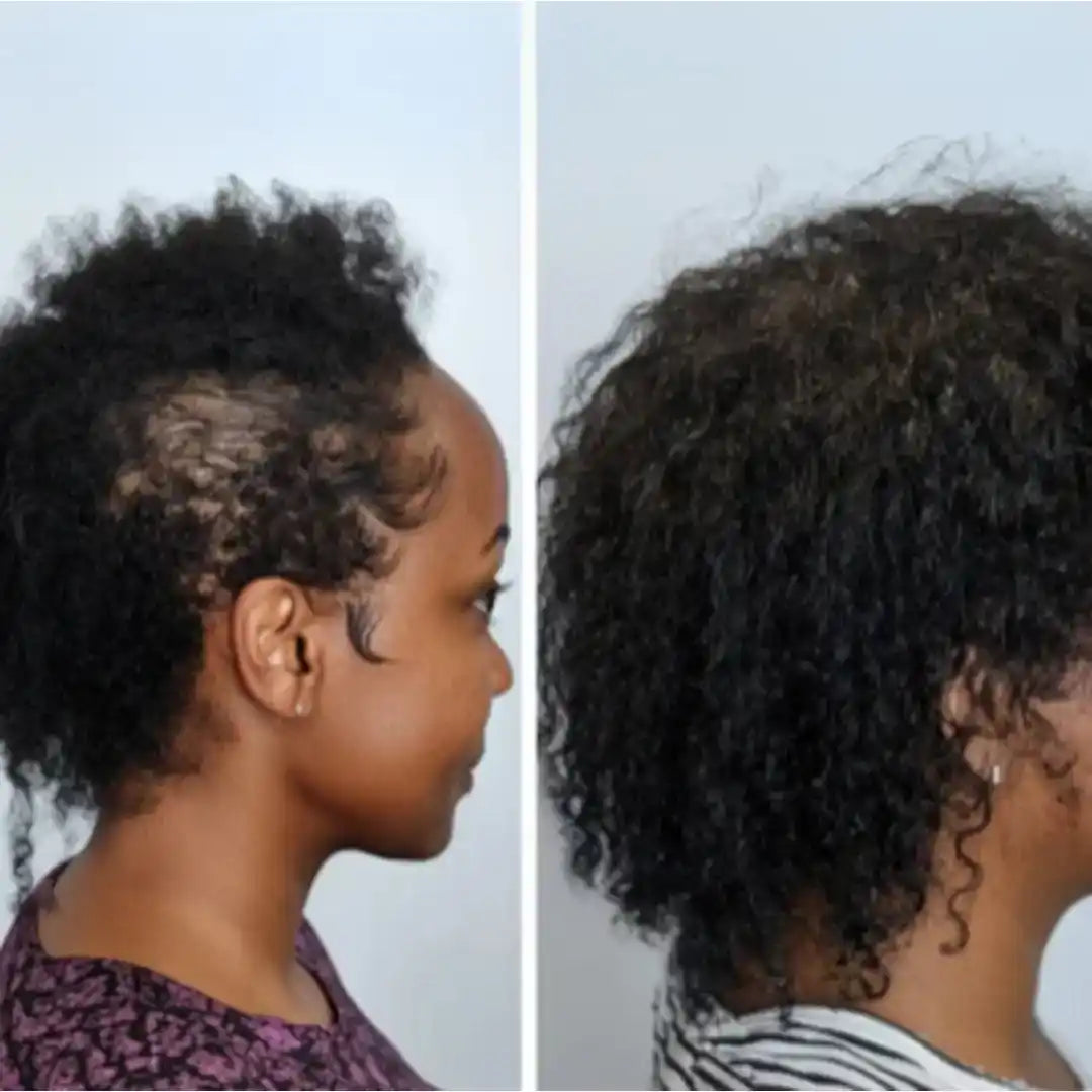 Les cheveux d'une femme avant et après un traitement contre la perte de cheveux, montrant une repousse significative et une densité accrue.