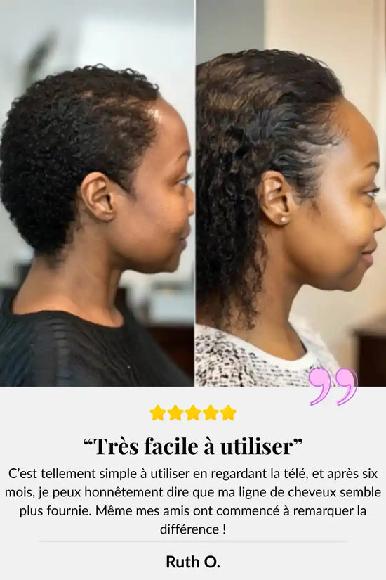 Images avant et après montrant la croissance des cheveux et l'amélioration de la densité capillaire.